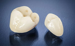 CEREC technology for same day crown fittings