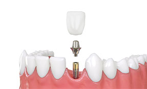 Dental Implants procedure illustration