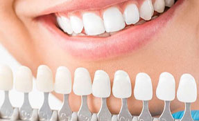 Dental Veneers for a brighter and more confident smile
