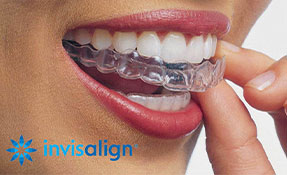 Modern Invisible braces