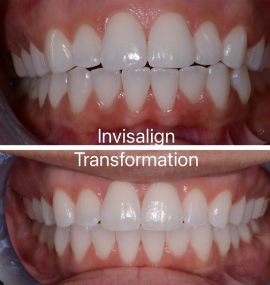 Invisalign treatment before and after