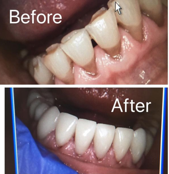 Invisalign treatment before and after