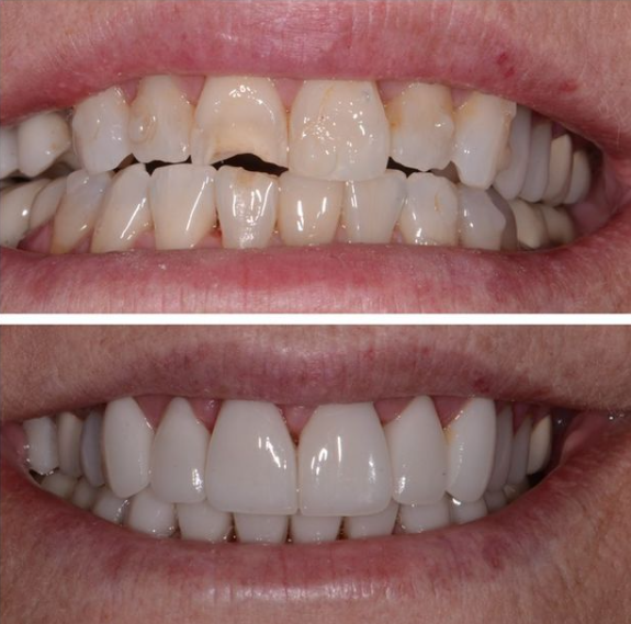 smile repair before and after
