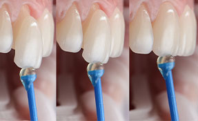 Teeth Correction for chipped and misshapen teeth