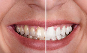 Teeth whitening Procedure for bright smiles